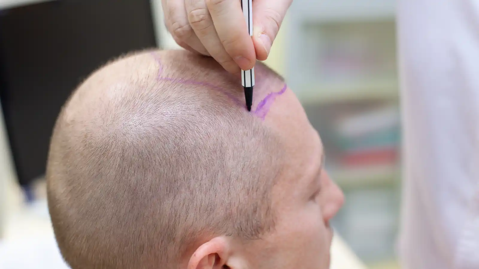FUE vs DHI vs FUT: Which Hair Transplant Technique Is Right for You?